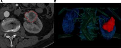 Radiomics analysis of contrast-enhanced CT scans can distinguish between clear cell and non-clear cell renal cell carcinoma in different imaging protocols